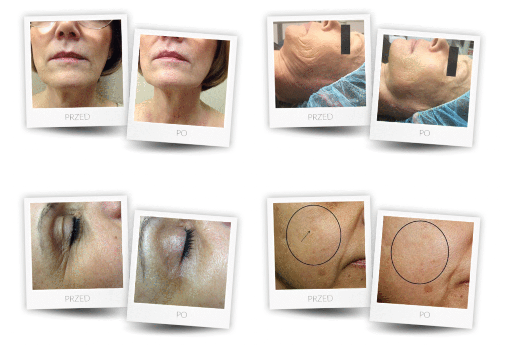 geneo efekty geneo efekty